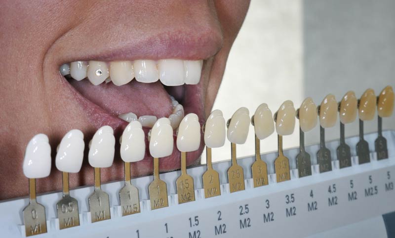 Tooth color composite
