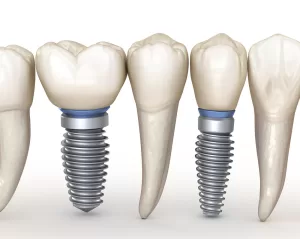 Dental implants before and after