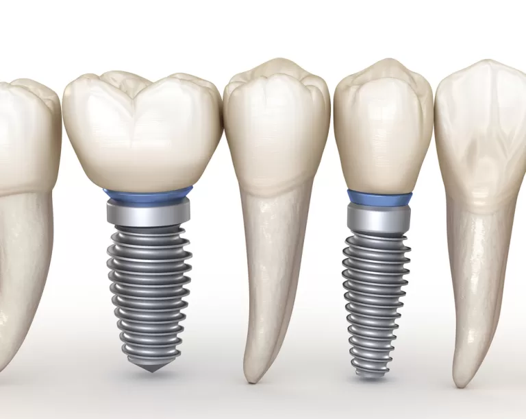 Dental implants before and after