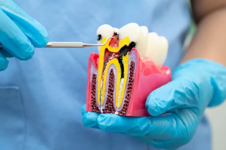 Root canal before and after
