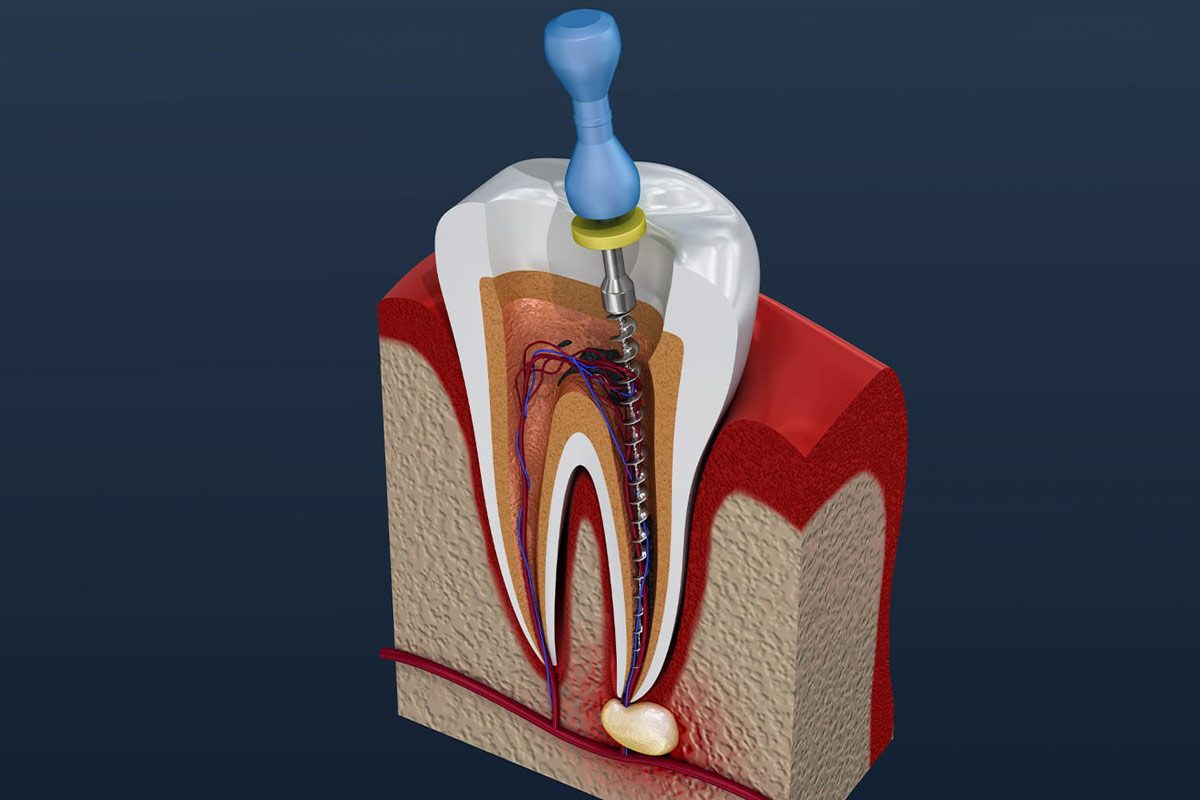 BD-RootCanal-002